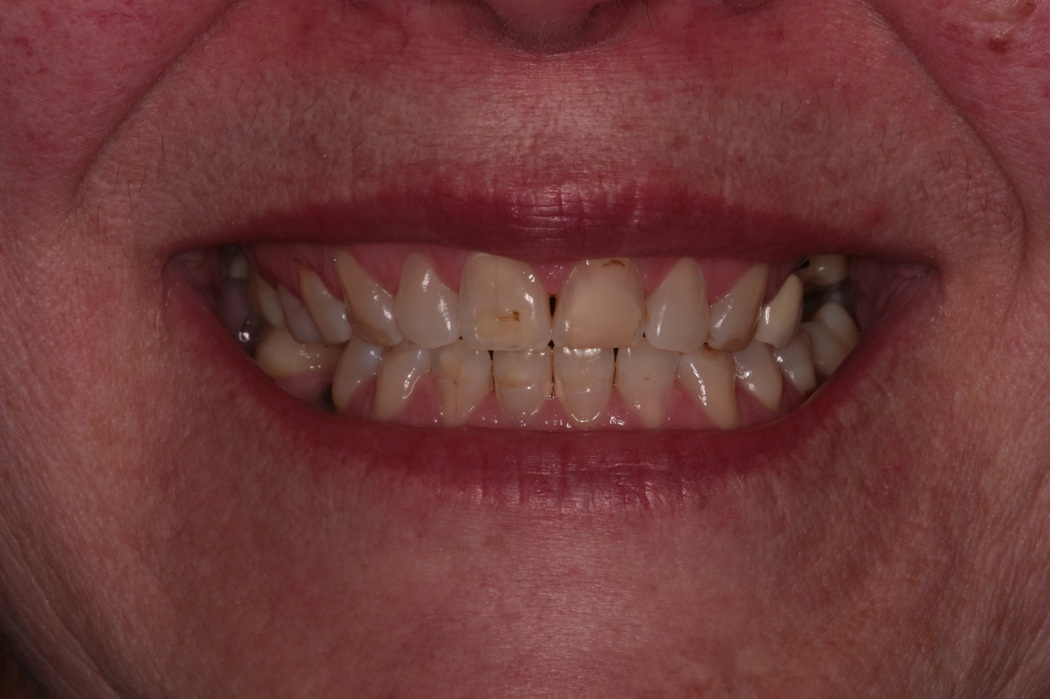 Antes