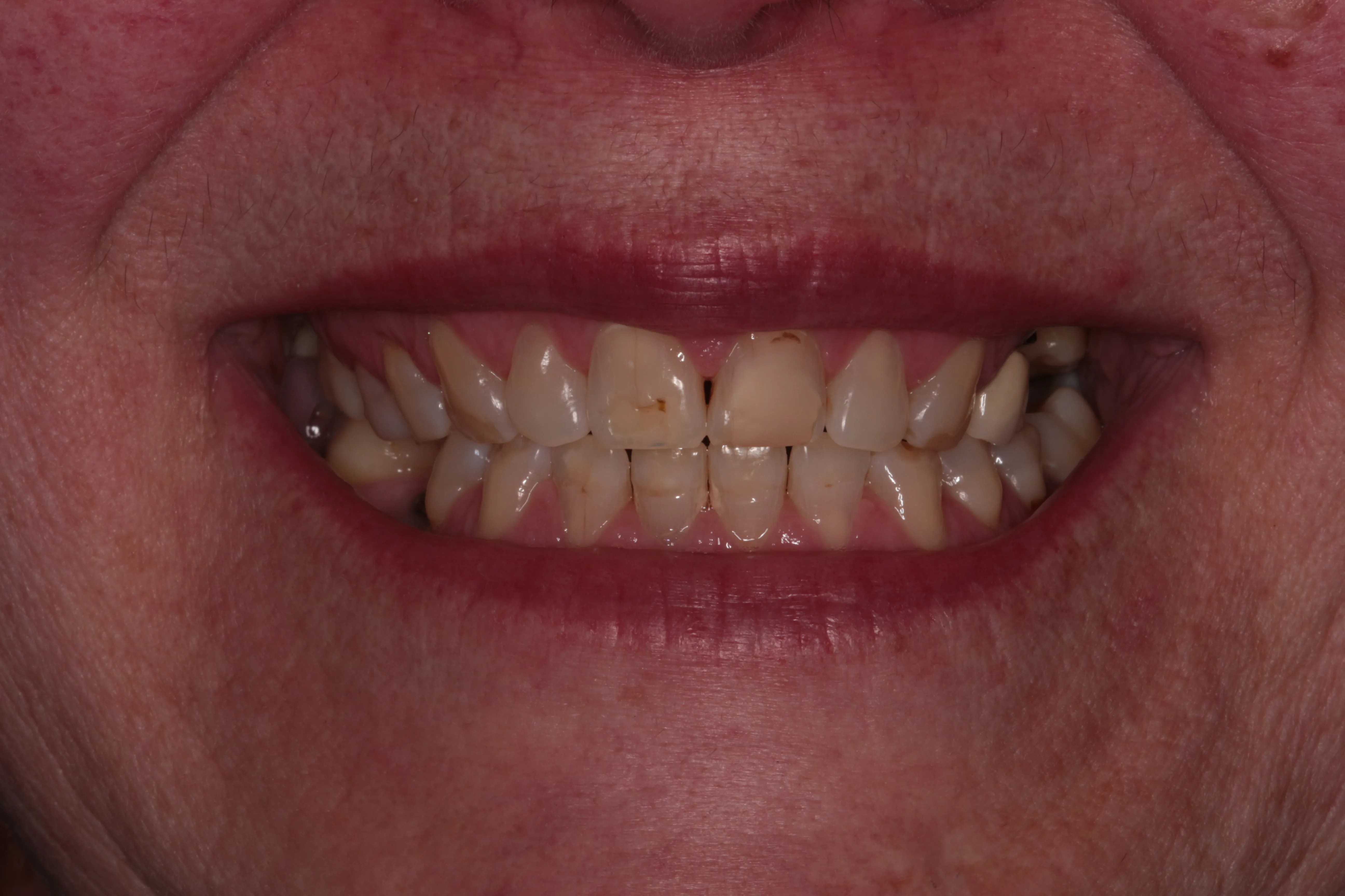 Antes
