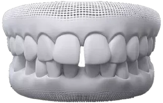 Diastema