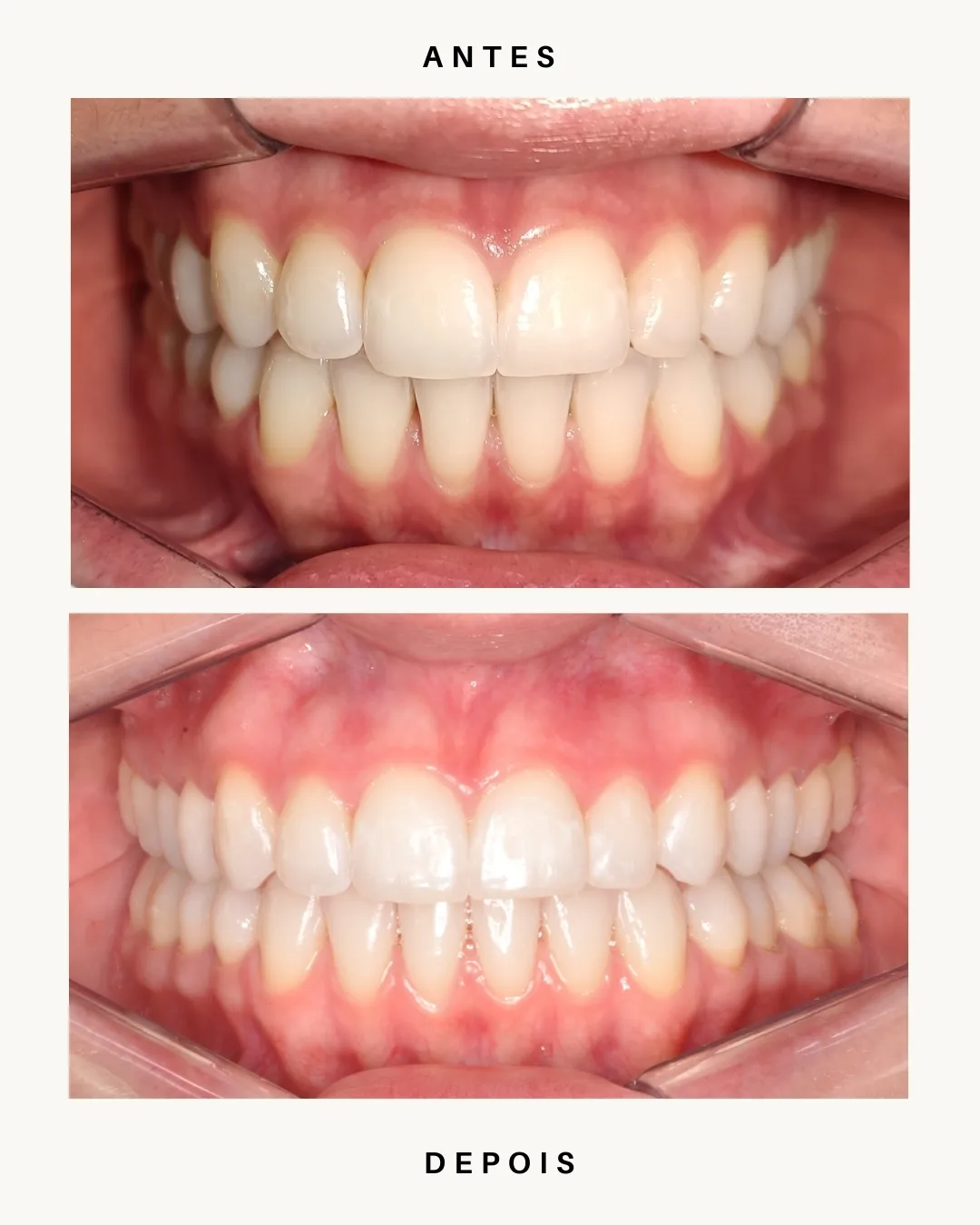 Resultados Invisalign OralClin